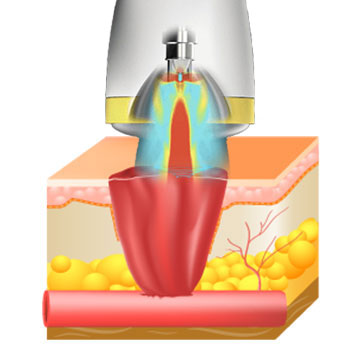 softWave is applied to the injured area