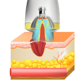 the Acoustic waves induce microtrauma in damaged tissues