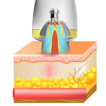 during the repair process, new blood vessels form, circulation increases, inflammation decreases